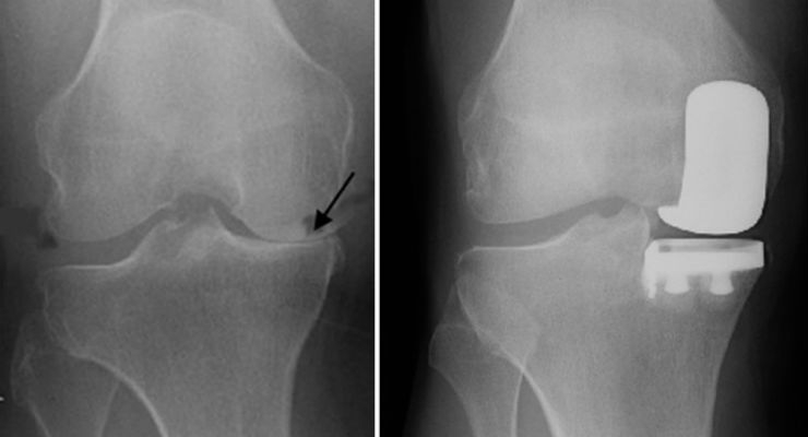 Partial-Knee-Replacement