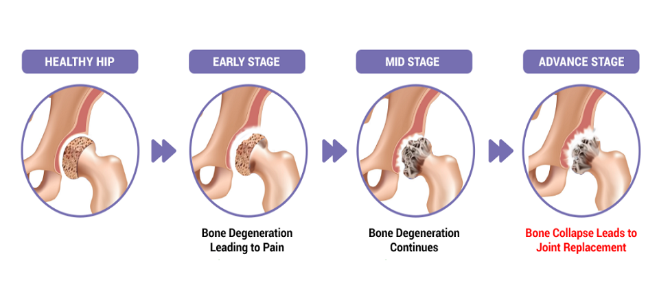 Avascular Necrosis and Treatment Options